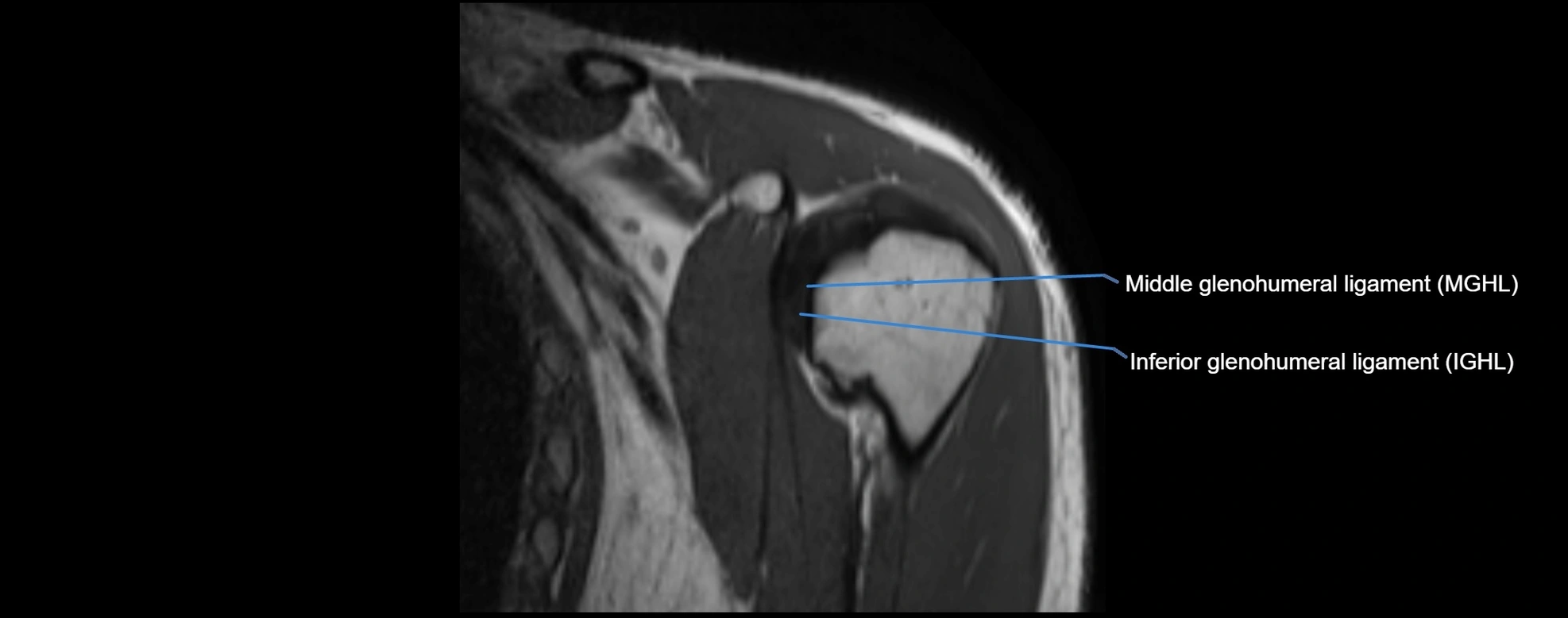 shoulder ligments coronal  cross sectional anatomy 3T MRI AI enhanced radiology image -img-00001-00009.webp